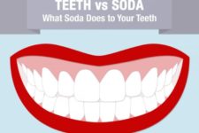 Teeth vs Soda - What Soda Does to Your Teeth